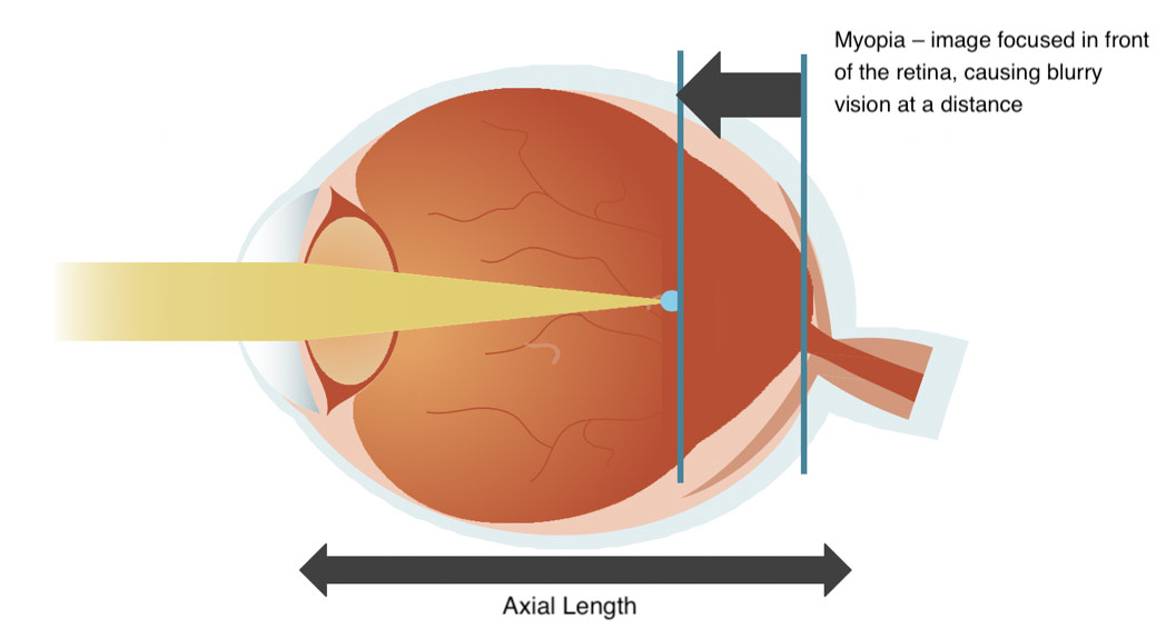 Myopia Illustration