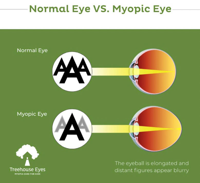 Normal Eye vs. Myopic Eye